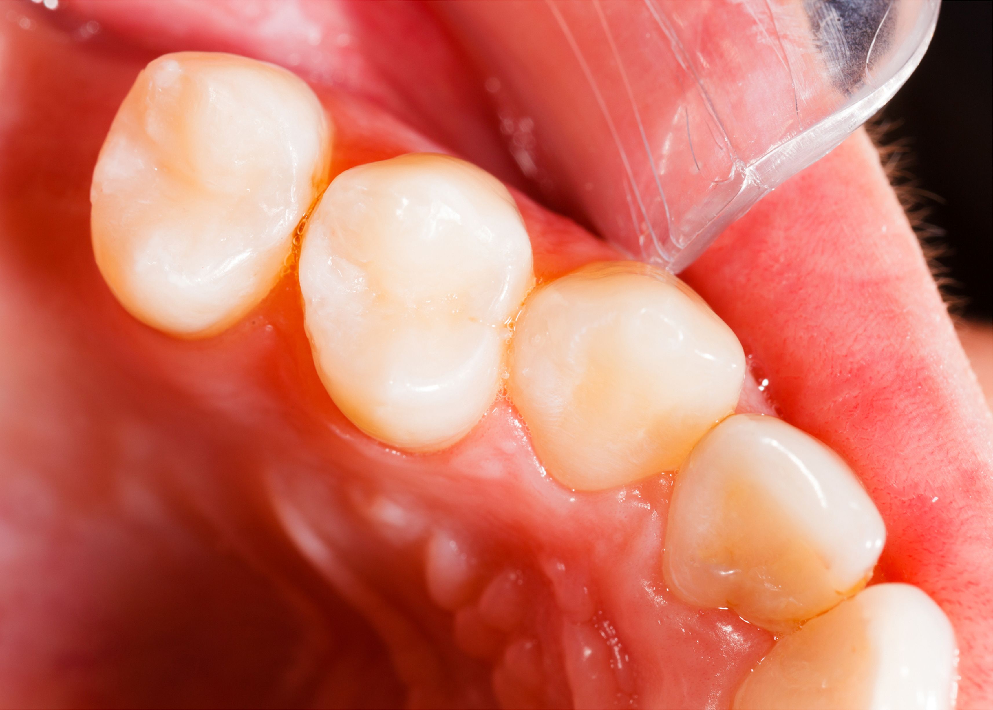 Tooth colored fillings