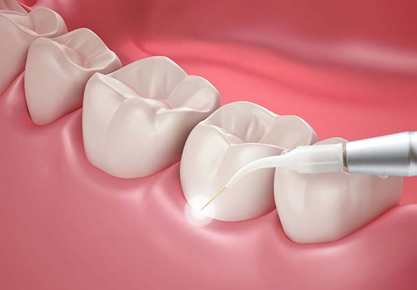 An illustration of a dental laser contouring the gum line