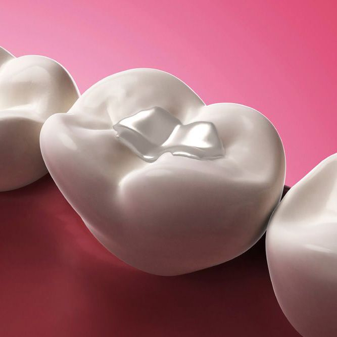 3-D graphic demonstrating placement of filling 