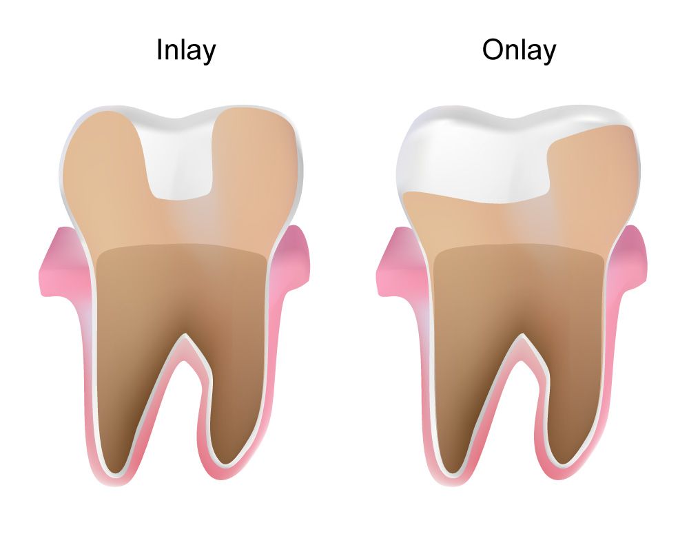 Inalys and onlays